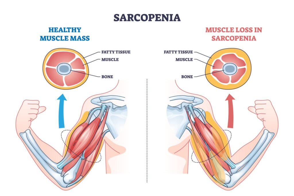 Illustration comparing healthy muscle mass cross-section to sarcopenic muscle loss.